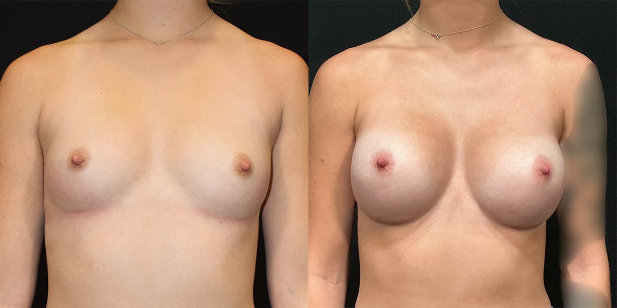 Breast Augmentation Before & After Gallery - Patient 249024 - Image 1