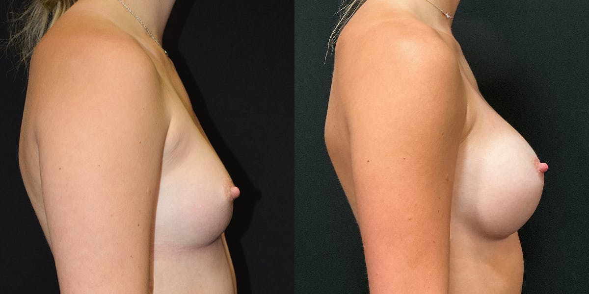 Breast Augmentation Before & After Gallery - Patient 249024 - Image 2