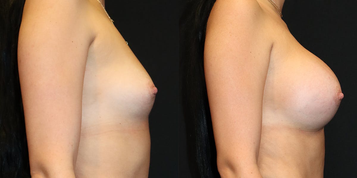 Breast Augmentation Before & After Gallery - Patient 339661 - Image 2