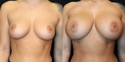 Breast Augmentation Before & After Gallery - Patient 320988 - Image 1