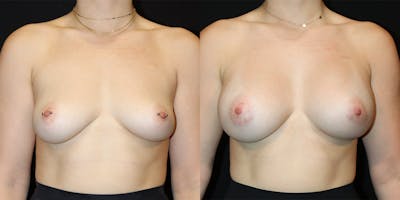 Breast Augmentation Before & After Gallery - Patient 220857 - Image 1