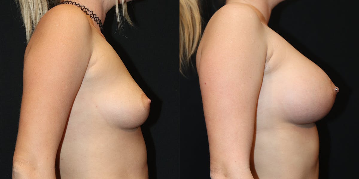 Breast Augmentation Before & After Gallery - Patient 537238 - Image 2