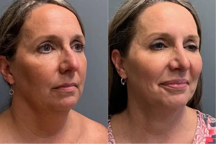 Chin augmentation, 41-60