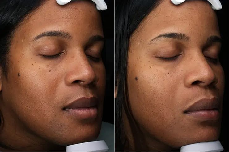 Laser hair reduction, 36-40