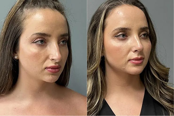 Rhinoplasty, 36-40