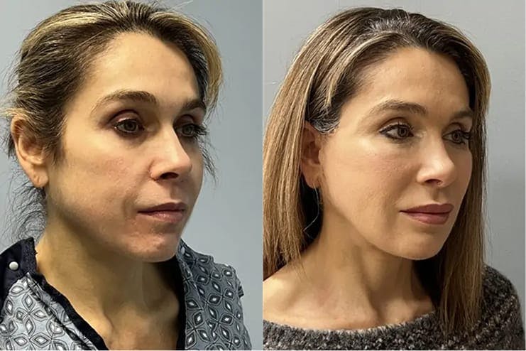 Facial rejuvenation, 51-60