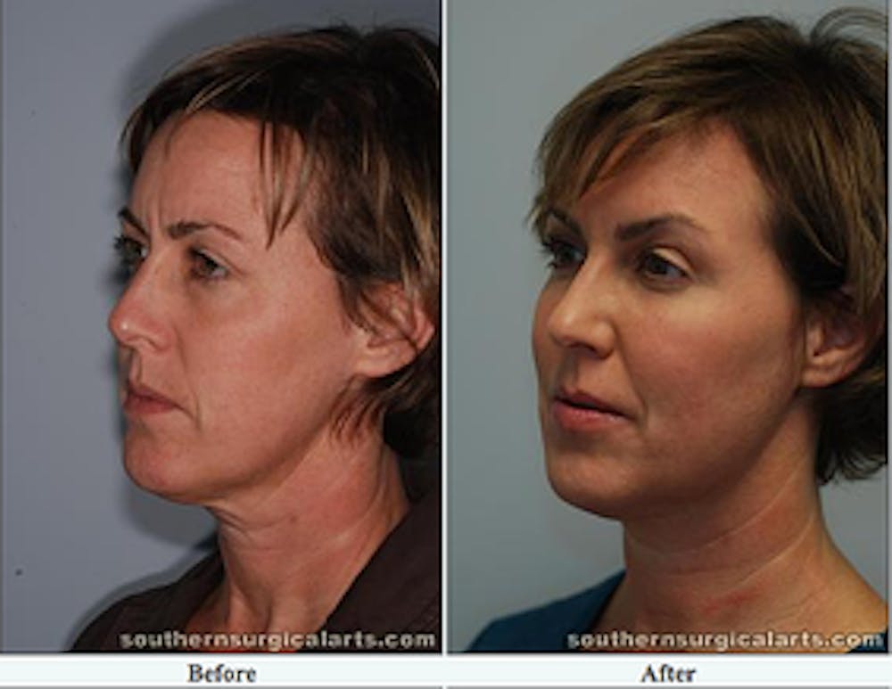 plastic surgery patient