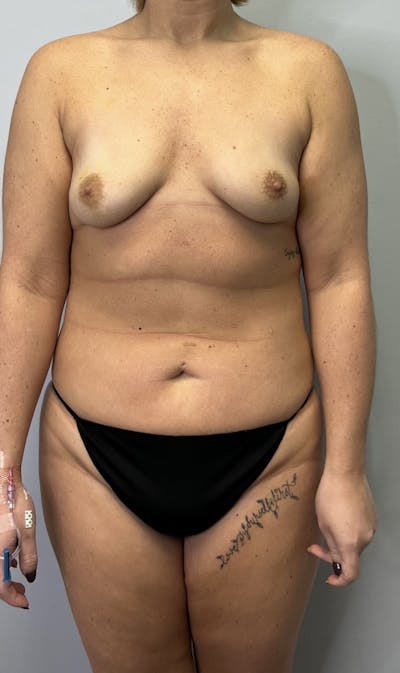 Breast Augmentation Before & After Gallery - Patient 665773 - Image 1
