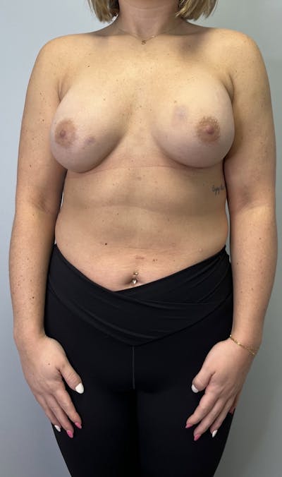 Breast Augmentation Before & After Gallery - Patient 665773 - Image 2
