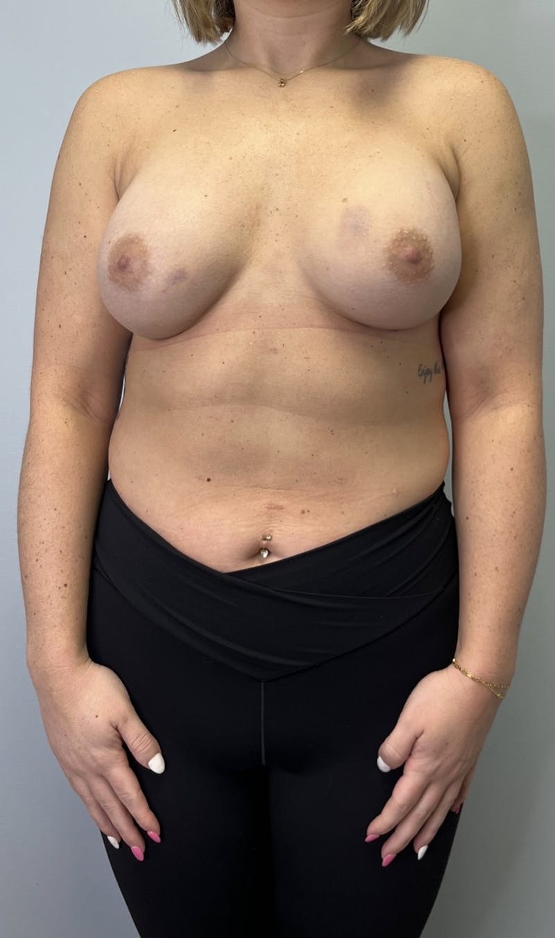 Breast Augmentation Before & After Gallery - Patient 665773 - Image 2