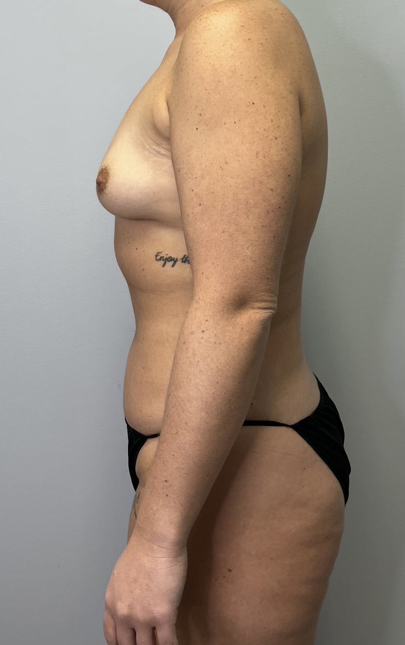 Breast Augmentation Before & After Gallery - Patient 665773 - Image 3