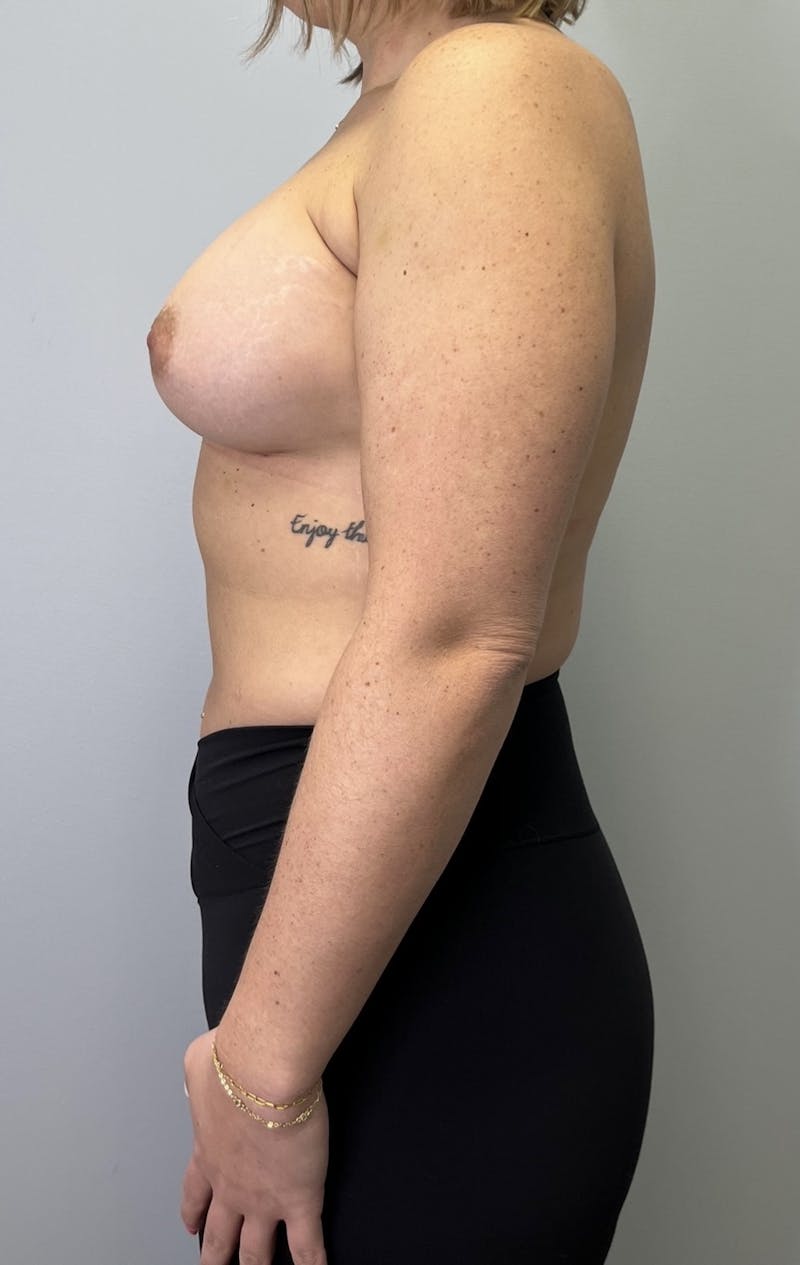 Breast Augmentation Before & After Gallery - Patient 665773 - Image 4