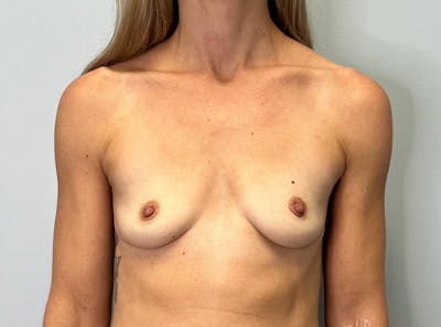 Breast Augmentation Before & After Gallery - Patient 256933 - Image 1