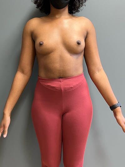 Breast Augmentation Before & After Gallery - Patient 111937 - Image 1
