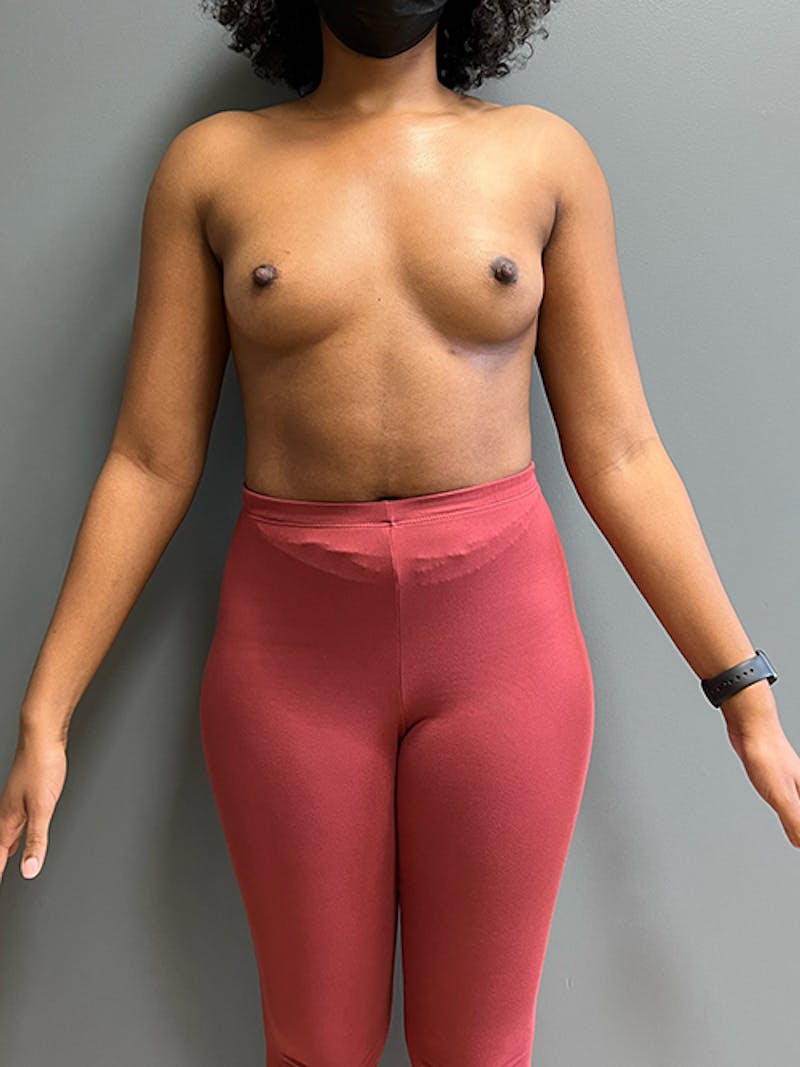 Breast Augmentation Before & After Gallery - Patient 111937 - Image 1
