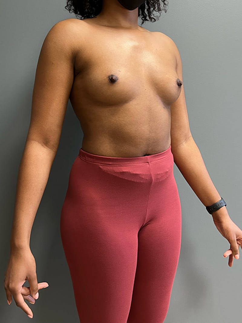 Breast Augmentation Before & After Gallery - Patient 111937 - Image 3