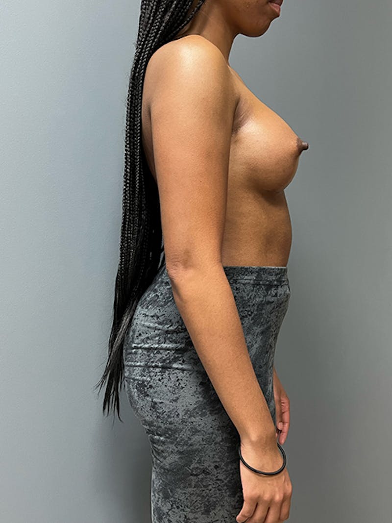 Breast Augmentation Before & After Gallery - Patient 111937 - Image 6