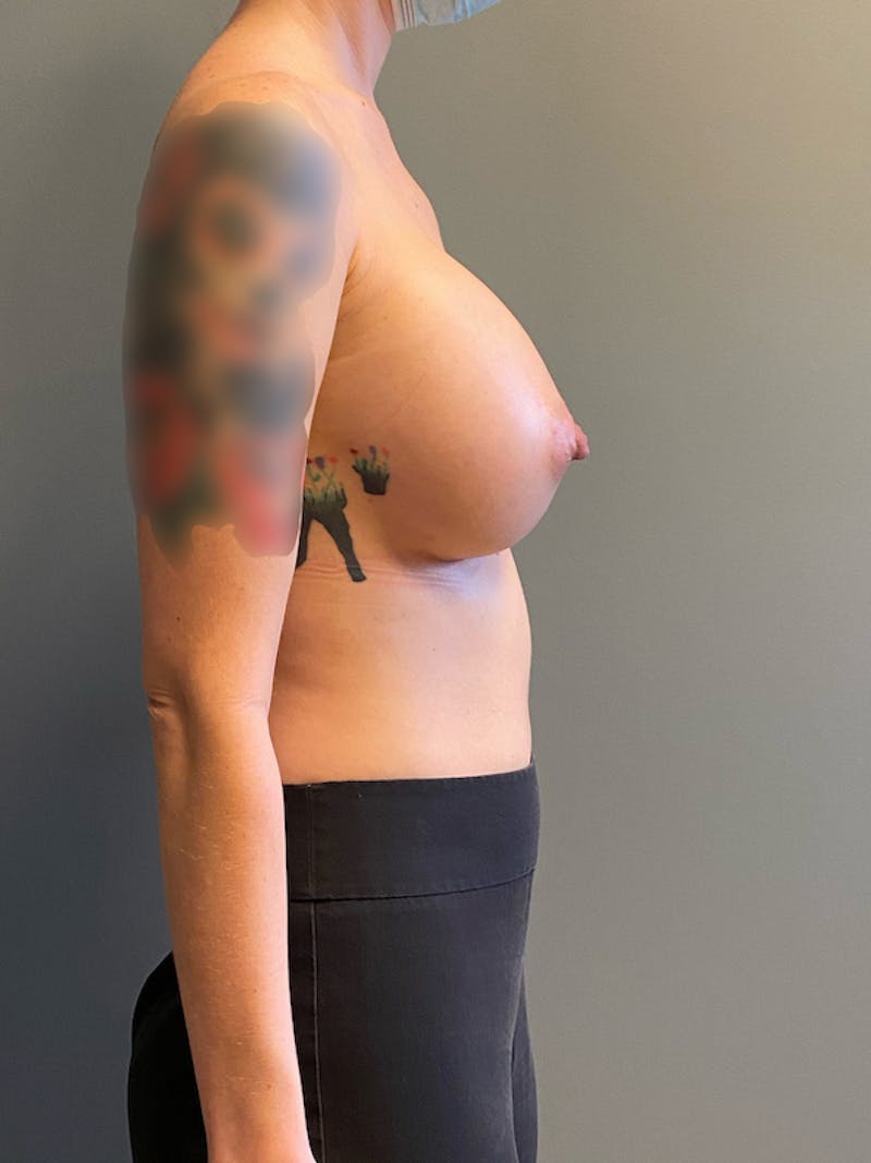 Breast Augmentation Before & After Gallery - Patient 290767 - Image 6