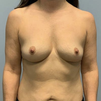 Breast Augmentation Before & After Gallery - Patient 416809 - Image 1