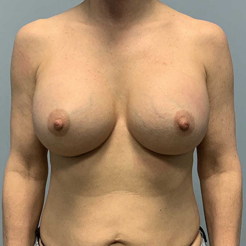 Breast Augmentation Before & After Gallery - Patient 416809 - Image 2