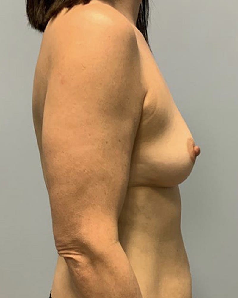Breast Augmentation Before & After Gallery - Patient 416809 - Image 5