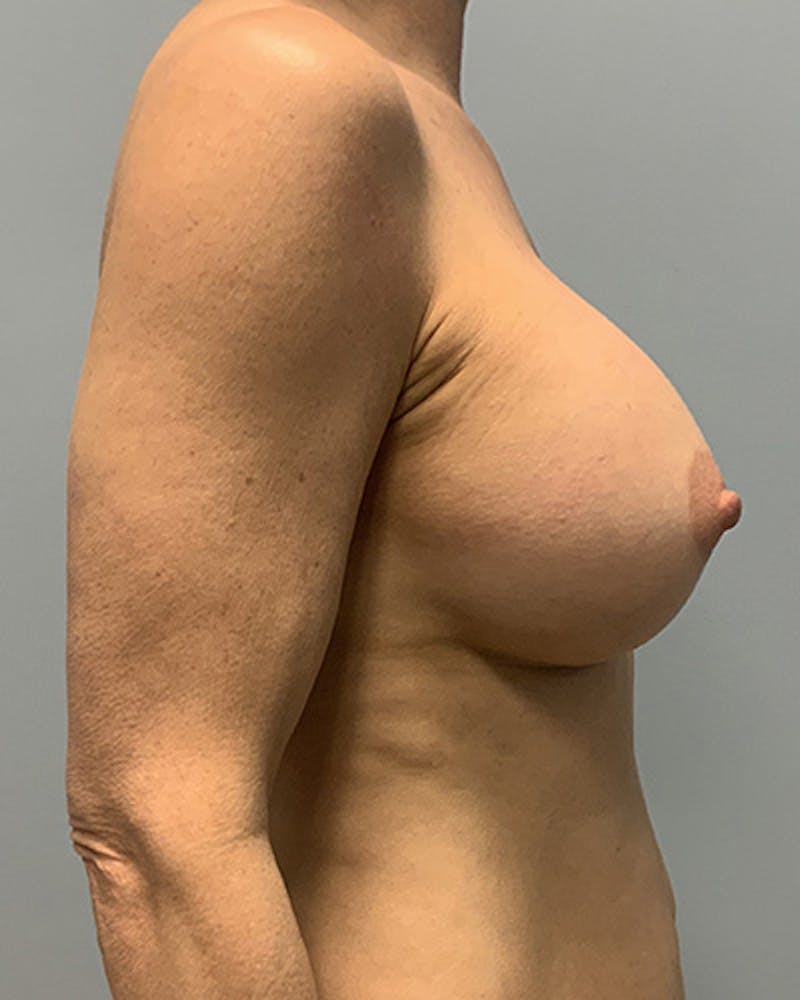 Breast Augmentation Before & After Gallery - Patient 416809 - Image 6