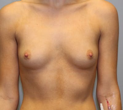 Breast Augmentation Before & After Gallery - Patient 167829 - Image 1
