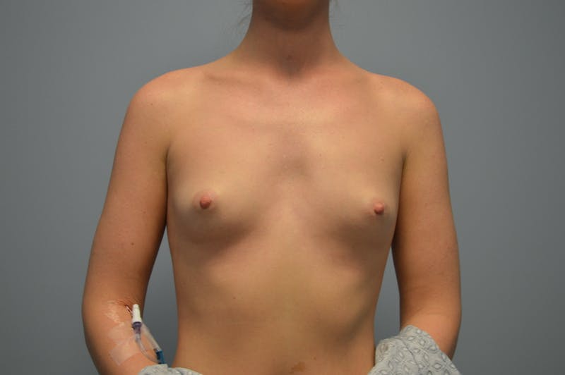 Breast Augmentation Before & After Gallery - Patient 134044 - Image 1