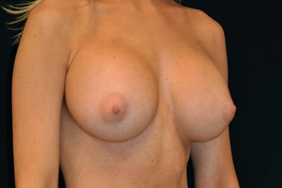 Breast Augmentation Before & After Gallery - Patient 454772 - Image 2