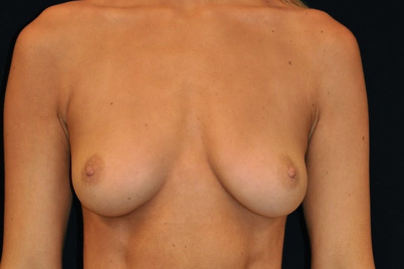 Breast Augmentation Before & After Gallery - Patient 454772 - Image 3