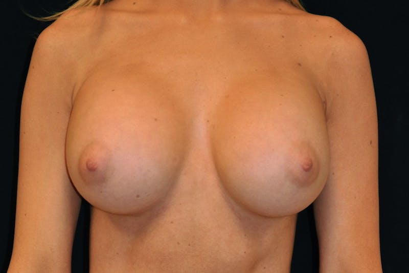 Breast Augmentation Before & After Gallery - Patient 454772 - Image 4