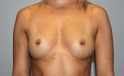 Breast Augmentation Before & After Gallery - Patient 301123 - Image 1
