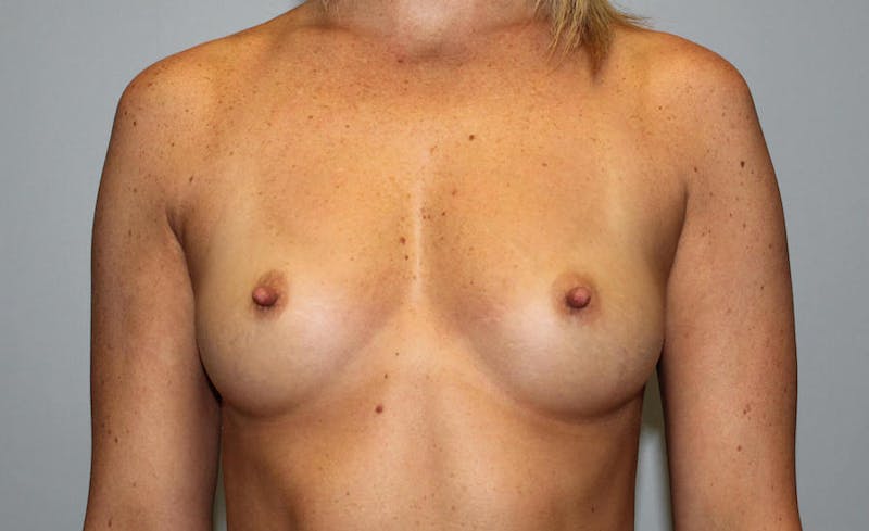 Breast Augmentation Before & After Gallery - Patient 301123 - Image 1