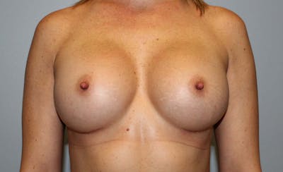 Breast Augmentation Before & After Gallery - Patient 301123 - Image 2