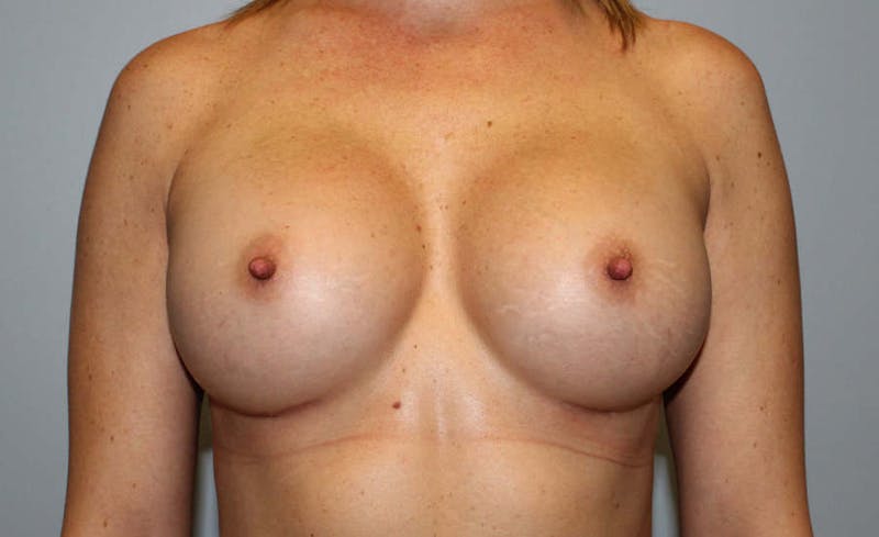 Breast Augmentation Before & After Gallery - Patient 301123 - Image 2