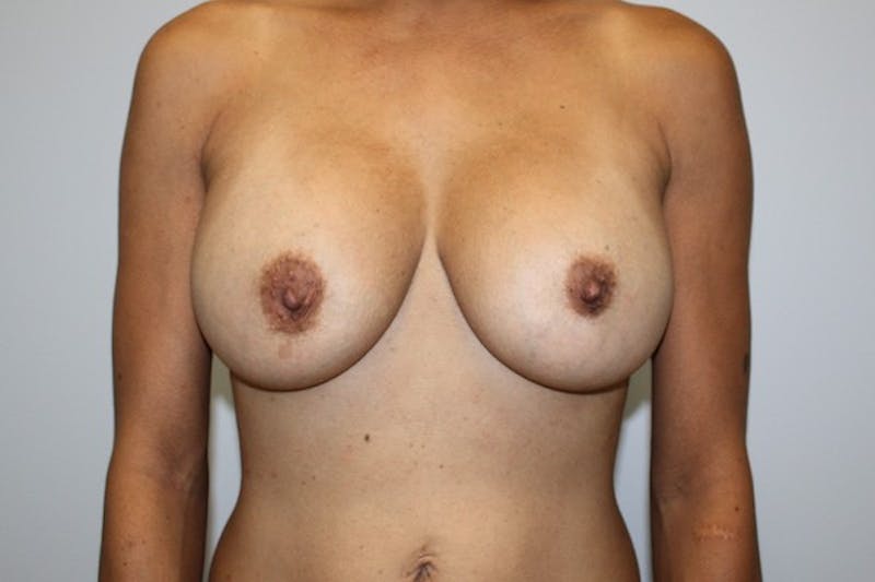 Breast Augmentation Before & After Gallery - Patient 201272 - Image 2