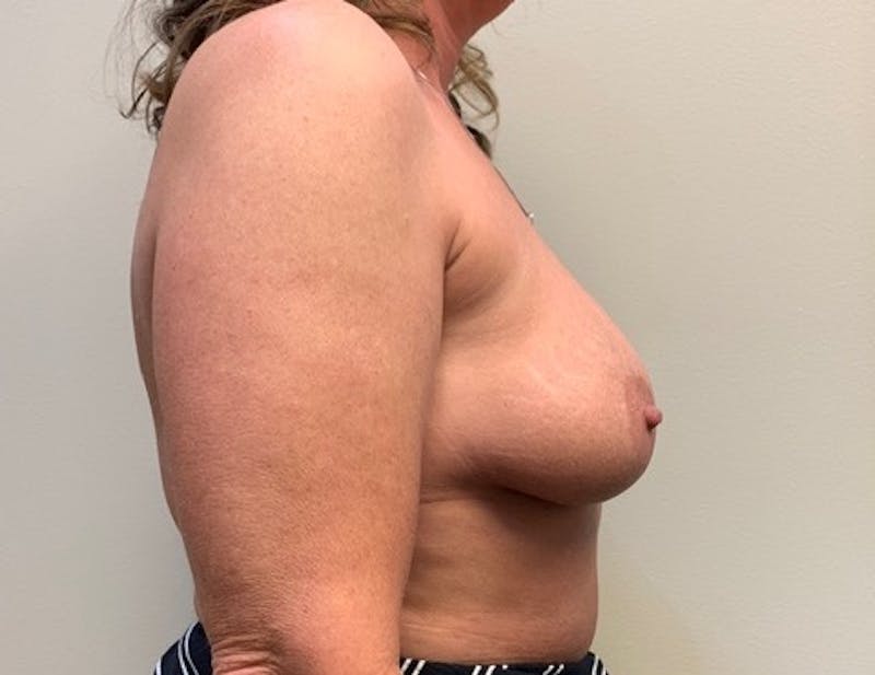 Breast Augmentation Before & After Gallery - Patient 171295 - Image 5