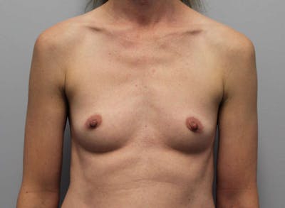 Breast Augmentation Before & After Gallery - Patient 135329 - Image 1
