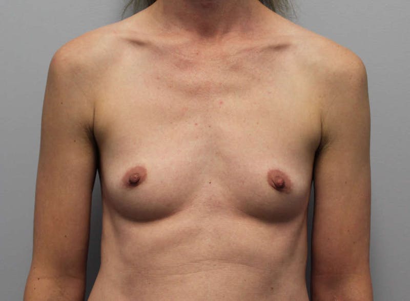 Breast Augmentation Before & After Gallery - Patient 135329 - Image 1