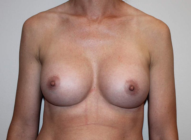 Breast Augmentation Before & After Gallery - Patient 135329 - Image 2