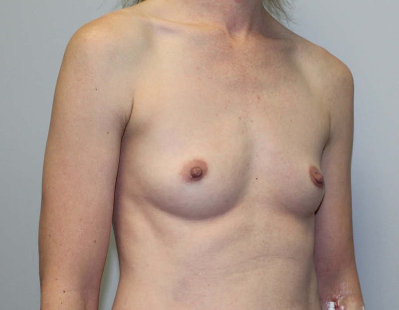 Breast Augmentation Before & After Gallery - Patient 135329 - Image 3