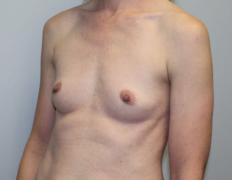 Breast Augmentation Before & After Gallery - Patient 135329 - Image 7