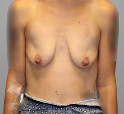 Breast Augmentation Before & After Gallery - Patient 383996 - Image 1