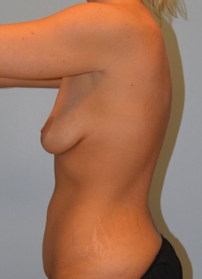 Breast Augmentation Before & After Gallery - Patient 150648 - Image 3
