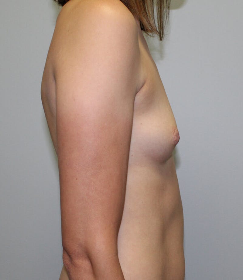 Breast Augmentation Before & After Gallery - Patient 408092 - Image 5