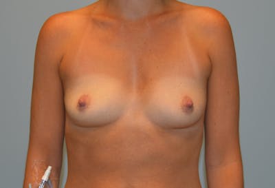 Breast Augmentation Before & After Gallery - Patient 293889 - Image 1