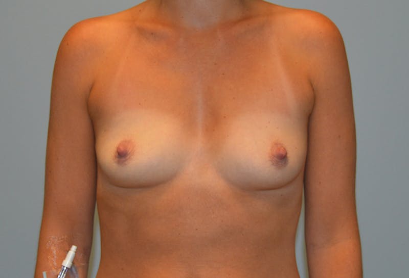 Breast Augmentation Before & After Gallery - Patient 293889 - Image 1