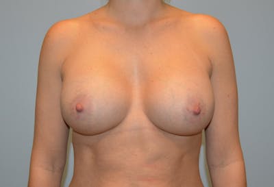 Breast Augmentation Before & After Gallery - Patient 293889 - Image 2
