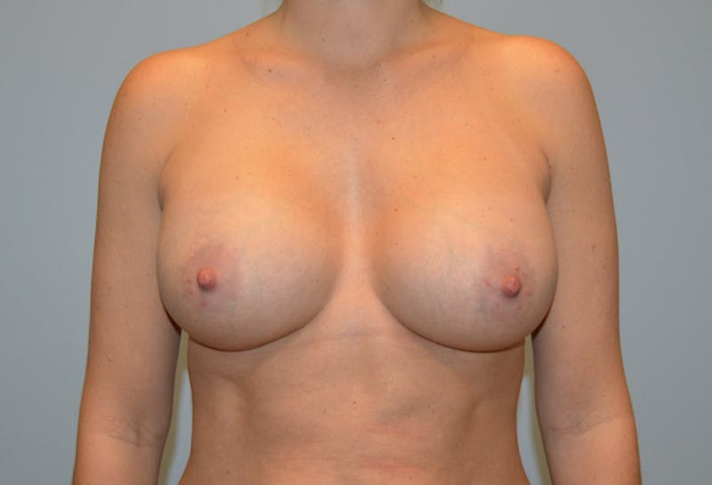 Breast Augmentation Before & After Gallery - Patient 293889 - Image 2