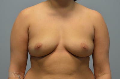 Breast Augmentation Before & After Gallery - Patient 525400 - Image 1